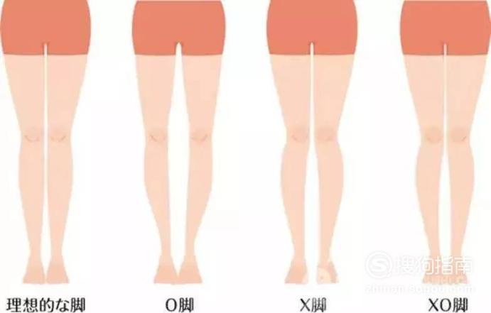 x型腿怎么矫正？