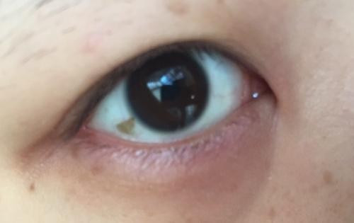 白眼球里出现黄斑是怎么回事