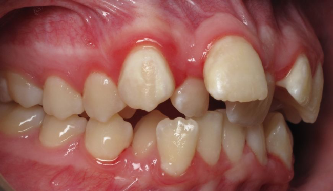 牙齿矫正为什么常常需要拔牙？