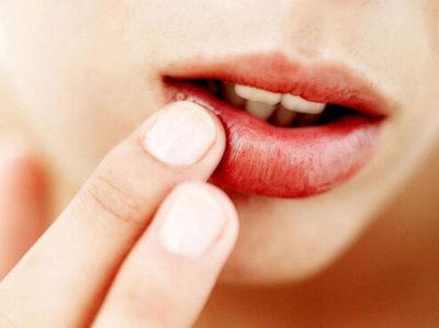 嘴唇干裂，缺少哪种维生素？