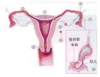 宫外孕是什么原因导致的