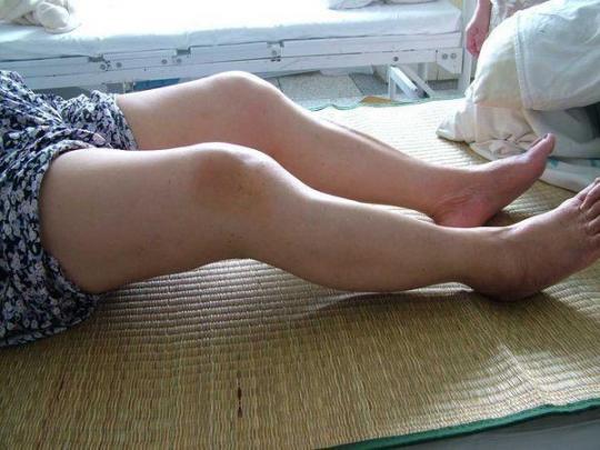 膝关节骨性关节炎的治疗