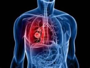 小细胞肺癌能活多久怎么治最好？