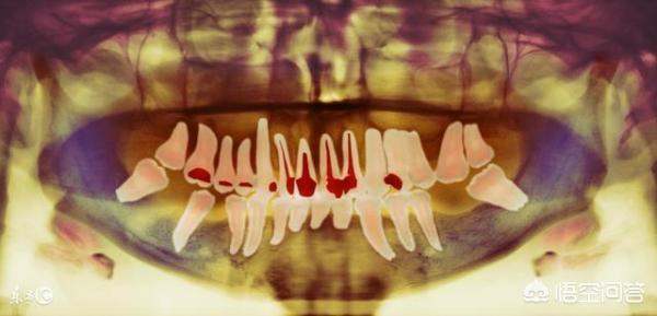 根管治疗后牙齿的寿命